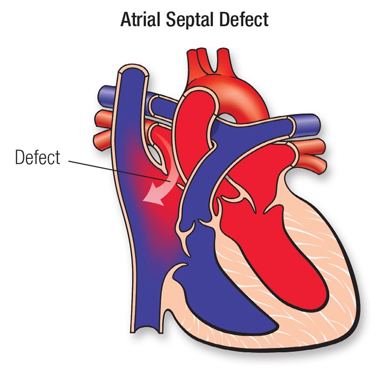 atrial-septal-defect.png