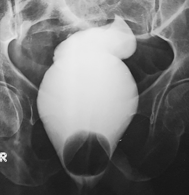 bird's beak sign on Gastrografin