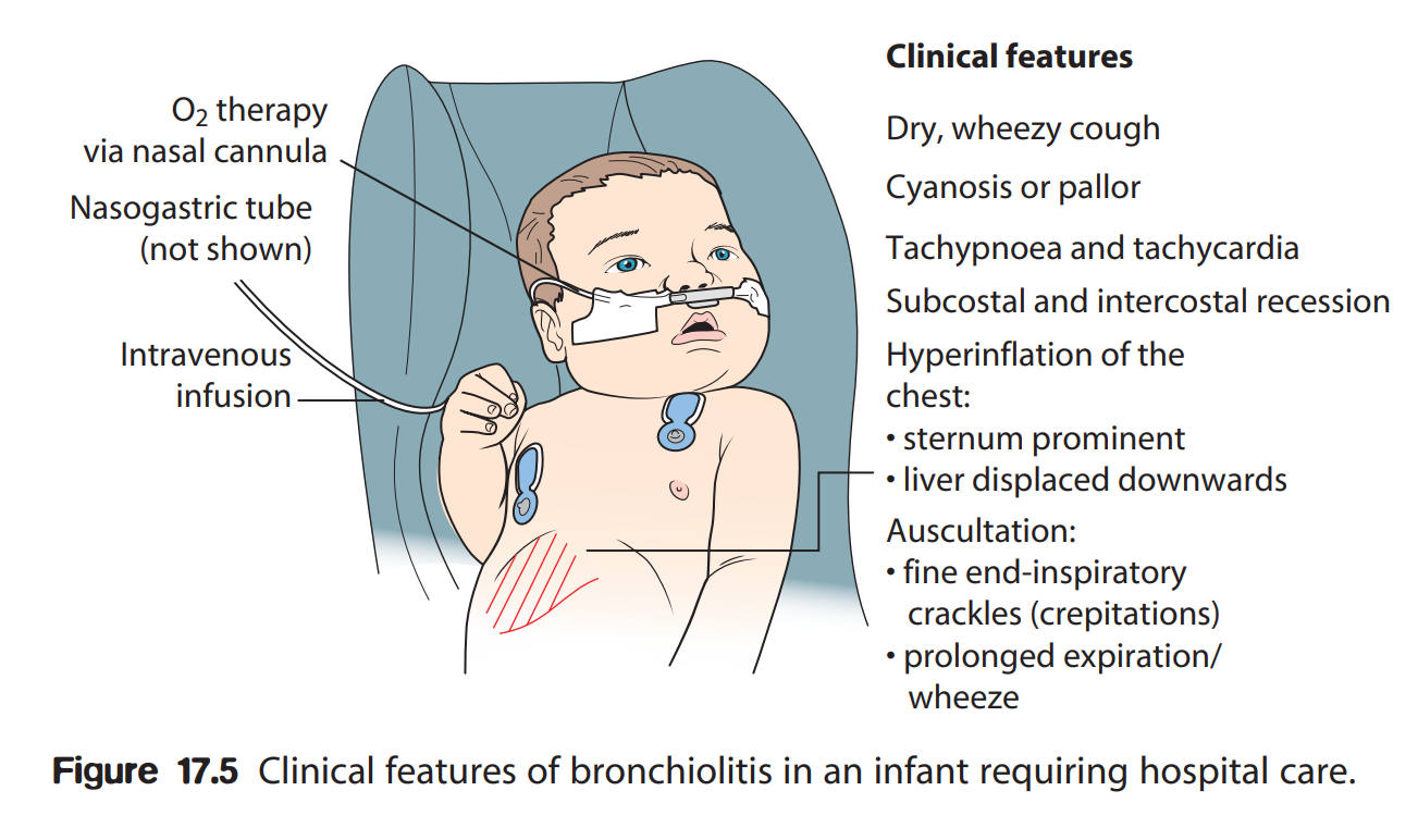 clinical-features-of-bronchiolitis-in-infant.png