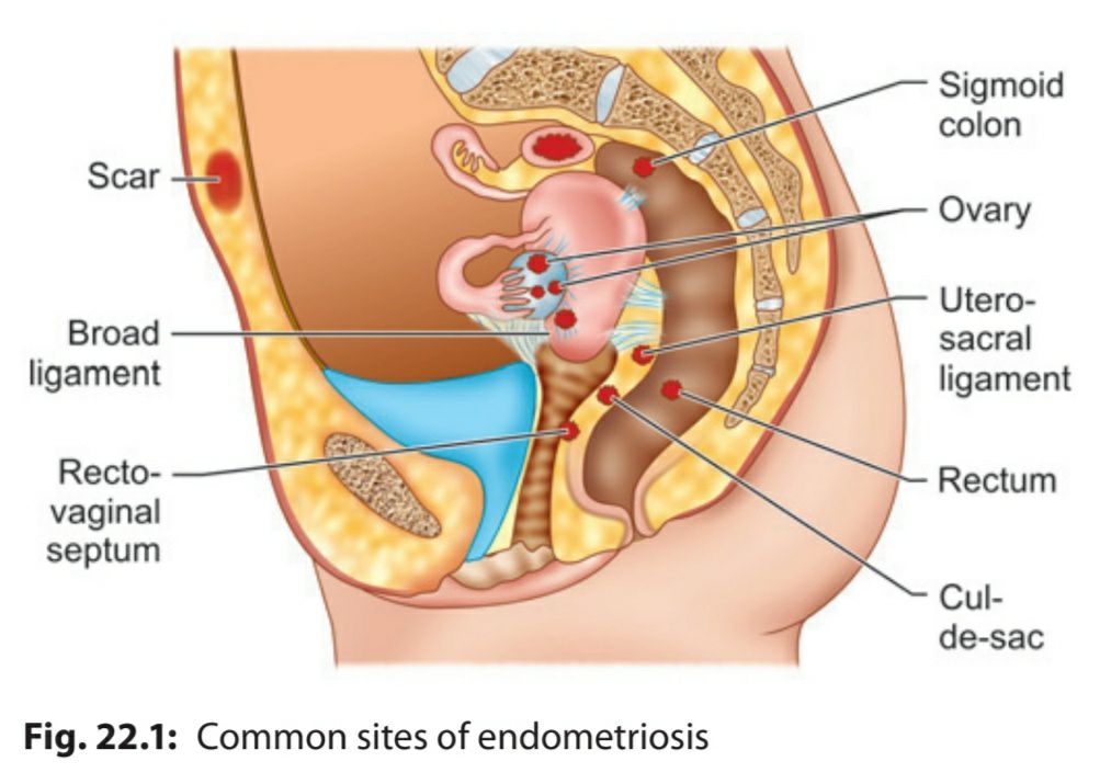 common-sites-endometriosis.jpeg