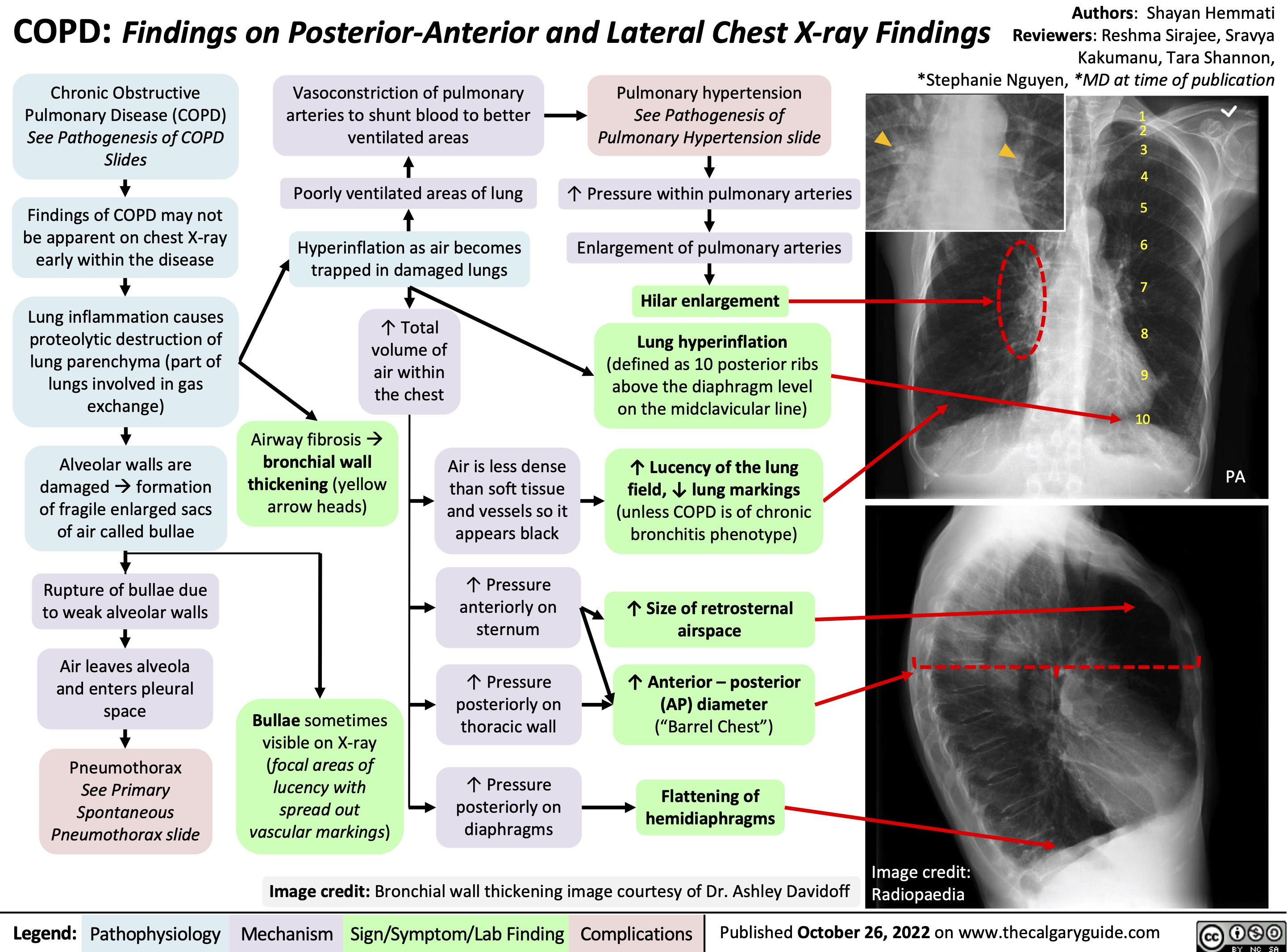 cxr-copd.png