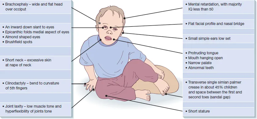 down-syndrome-features.png