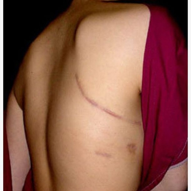lateral-thoracotomy-scar.png