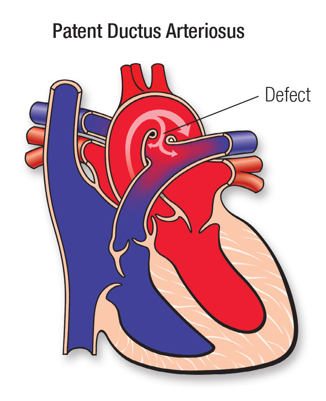 patent-ductus-arteriosus.png