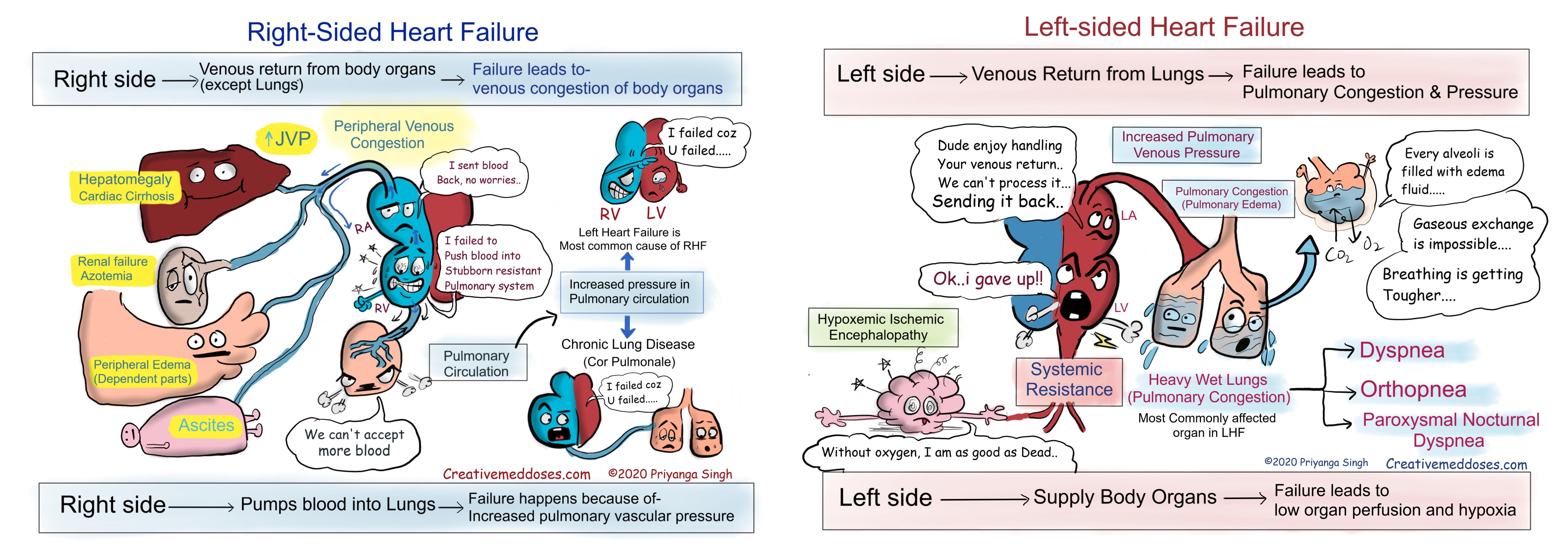 Pathophysiology of right-sided vs left-sided heart failure.