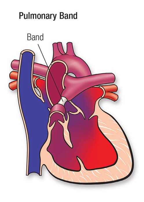 pulmonary-artery-banding.jpg
