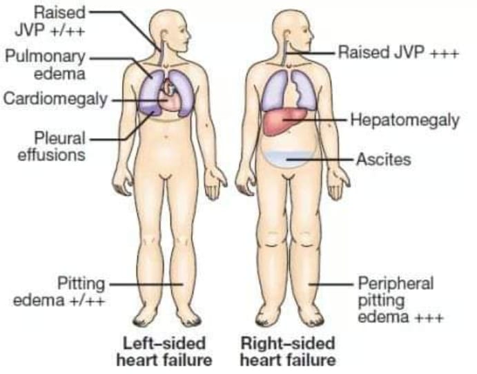 Signs of left-sided vs right-sided heart failure.