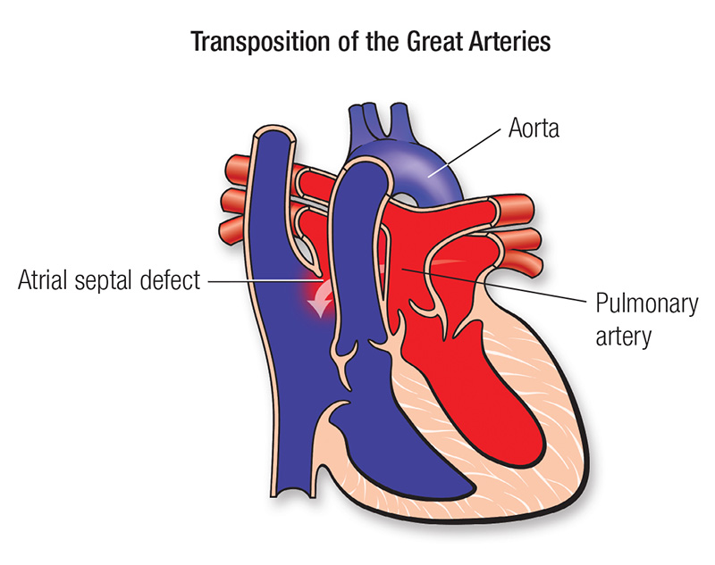 transposition-of-great-arteries.png