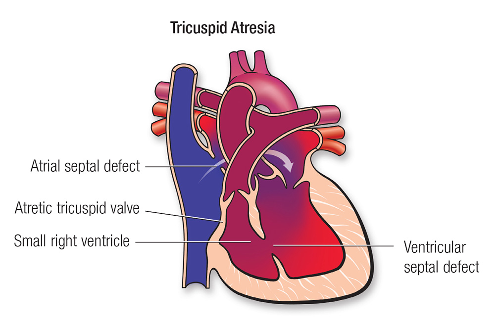 tricuspid-atresia.png