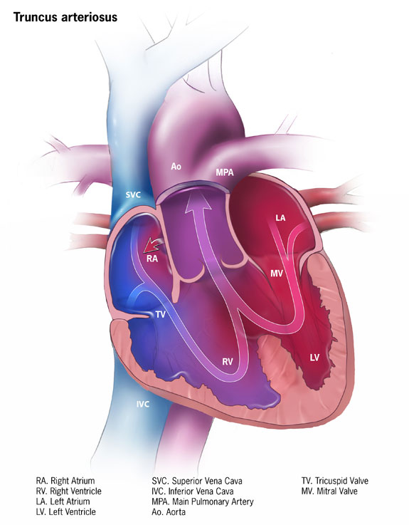 truncus-arteriosus.png